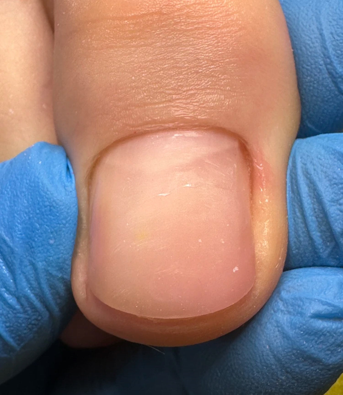 Toenail reconstruction February 28th