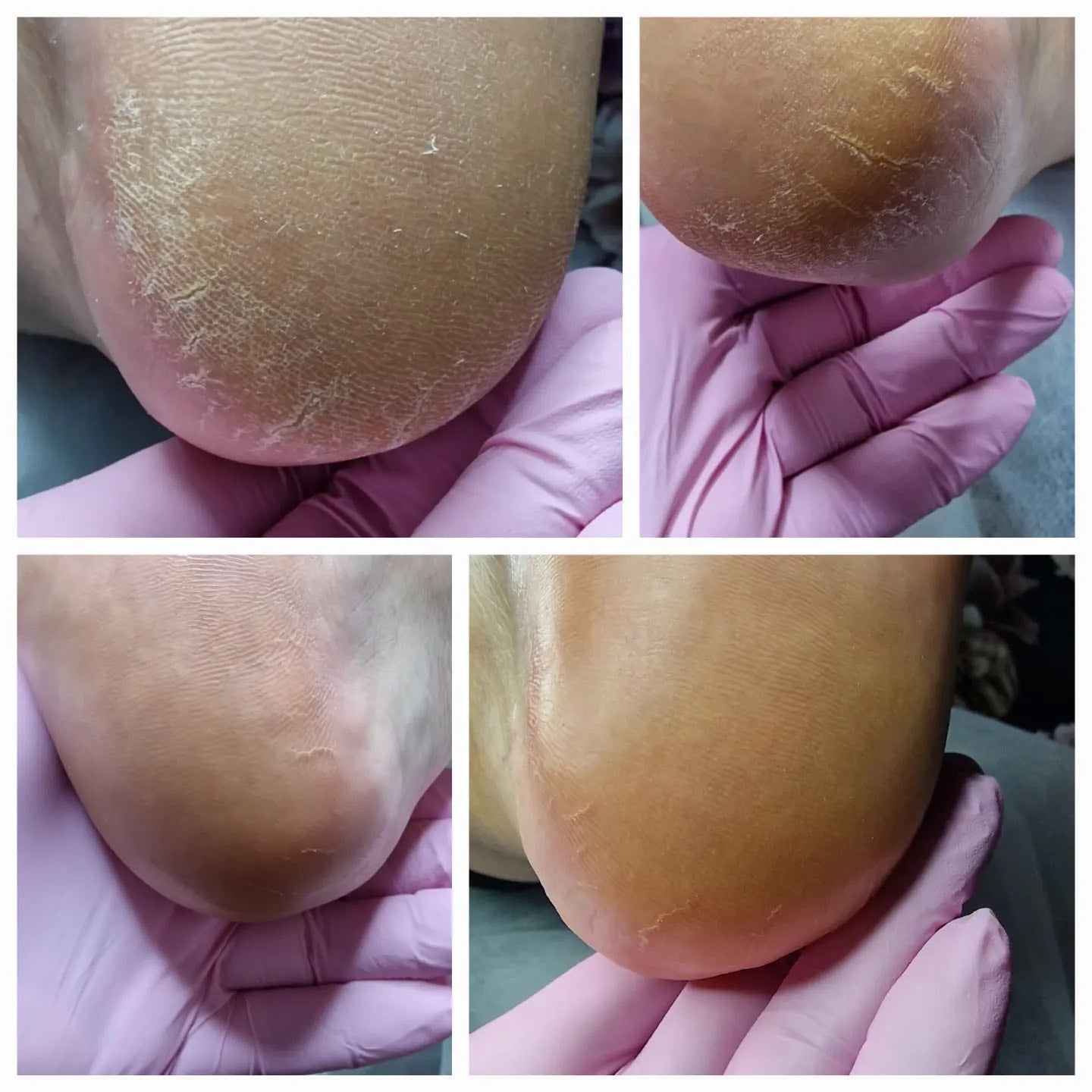 Advanced pedicure course - skin and nail pathologies