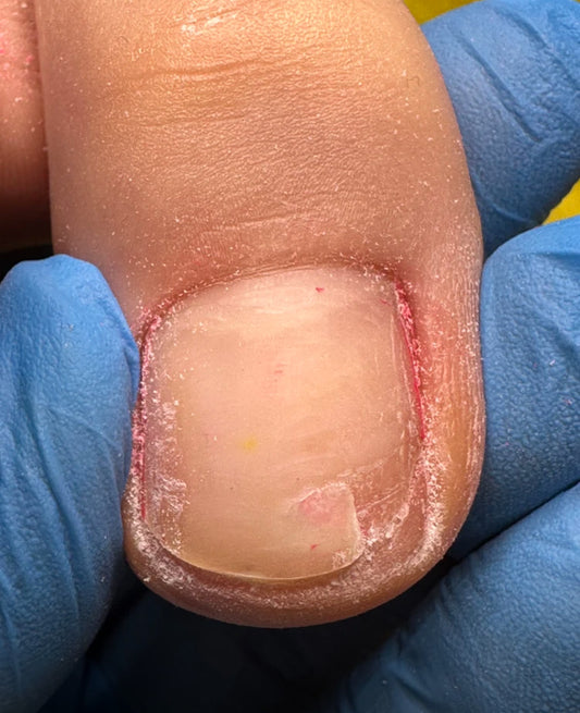 Toenail reconstruction February 28th